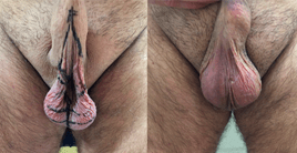 rejuvenecimiento testicular escroto cirugia estetica