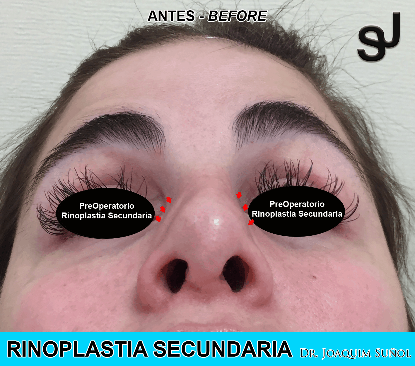 rinoplastia-secundaria-preop-joaquim-sunol-cirugia-plastica-estetica