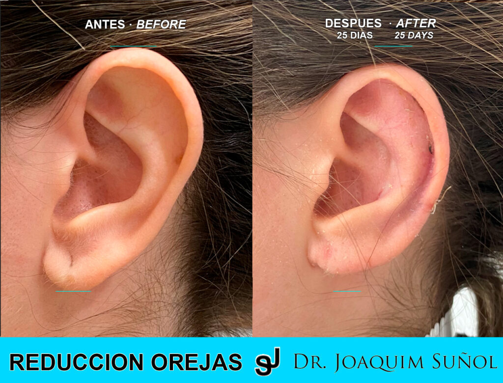 Ver ejemplo Otoplastia reduccion orejas cirugia estetica joaquim sunol