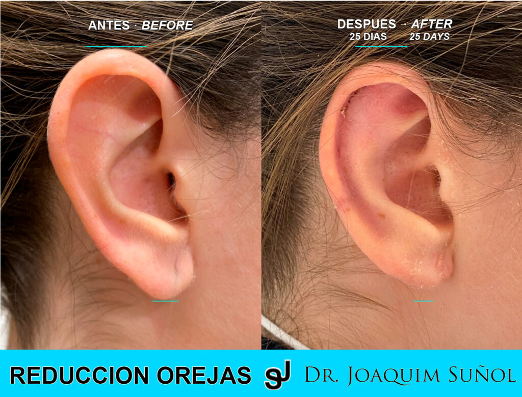 Ver ejemplo Otoplastia reduccion orejas cirugia joaquim sunol