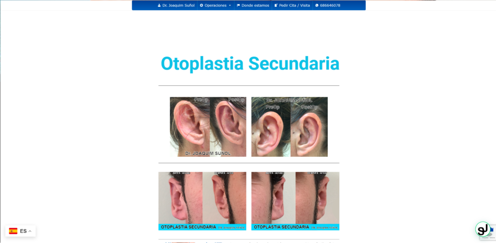 otoplastia-secundaria-joaquim-sunol